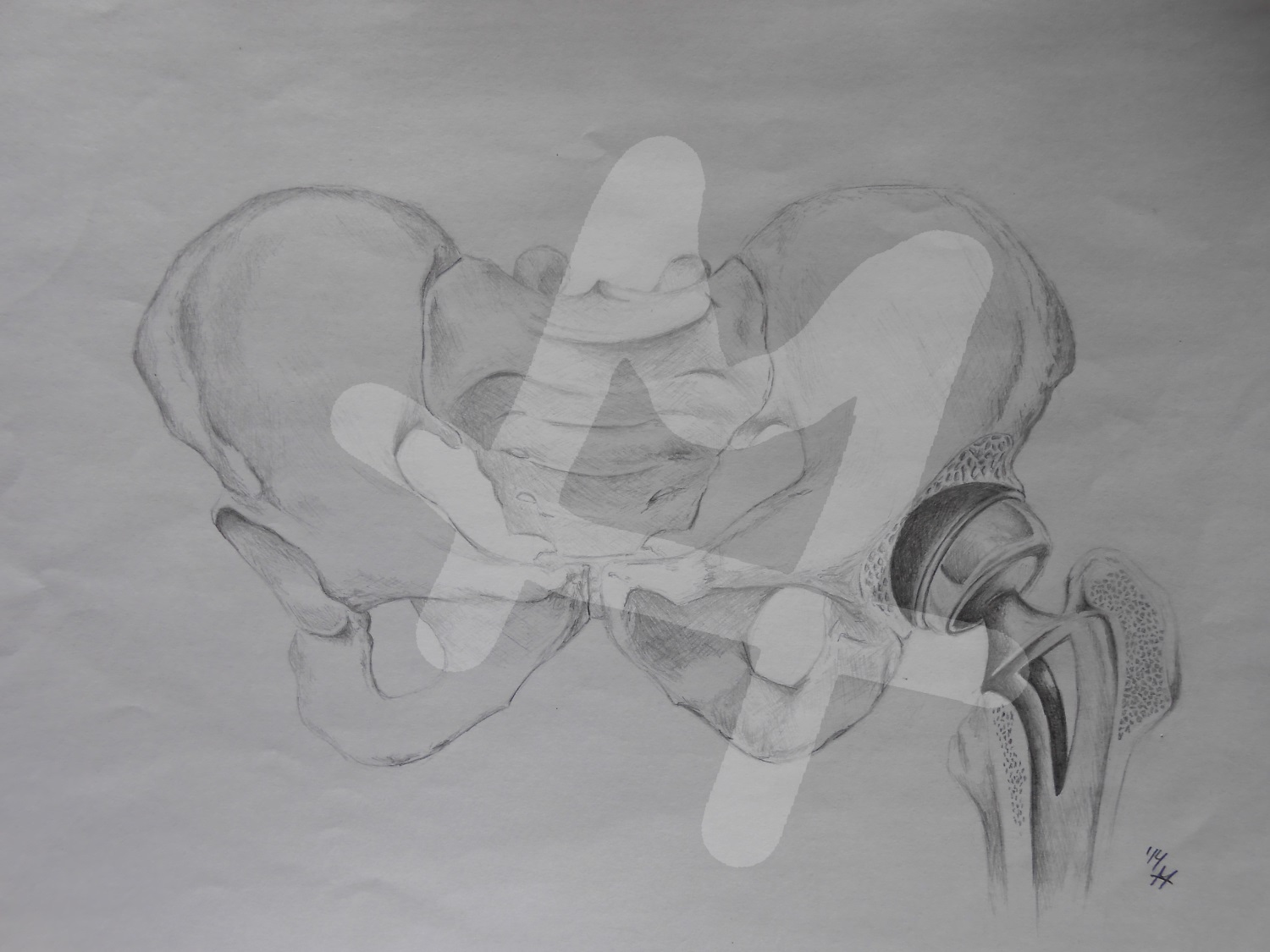Hip with artificial joint